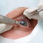 All About Cataracts